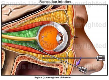 Intravitreal injection of steroids